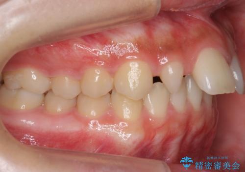 前歯が出っ歯ですきっ歯　抜かずに前歯を見た目良くの治療前