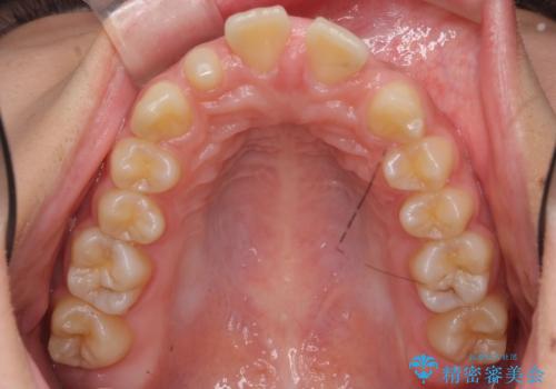 前歯が出っ歯ですきっ歯　抜かずに前歯を見た目良くの治療前