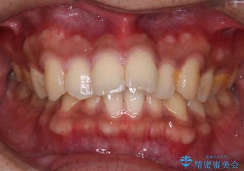 【審美ワイヤー】奥歯のガタガタを治したいの治療前
