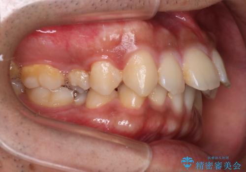 【審美ワイヤー】奥歯のガタガタを治したいの治療前