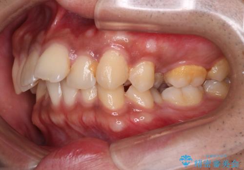 【審美ワイヤー】奥歯のガタガタを治したいの治療前