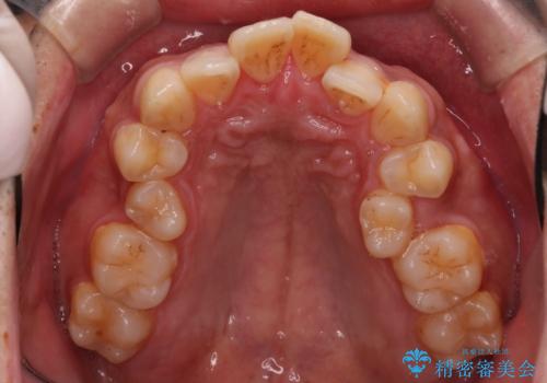 【審美ワイヤー】奥歯のガタガタを治したいの治療前