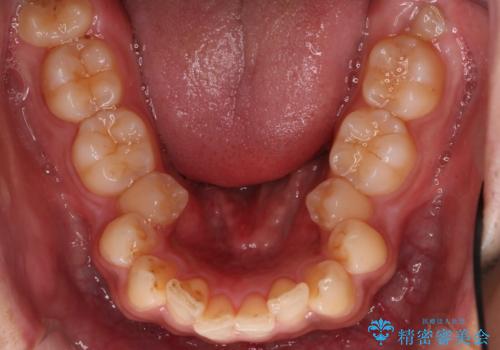 【審美ワイヤー】奥歯のガタガタを治したいの治療前