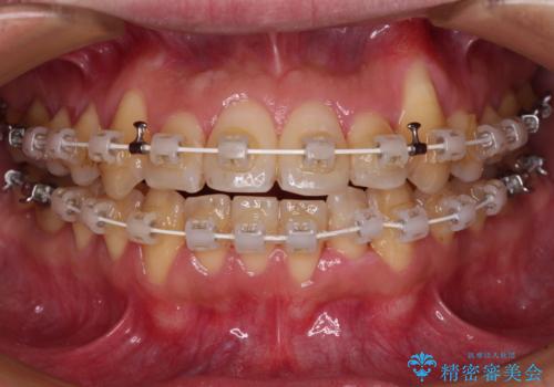 八重歯とクロスバイト　目立たないワイヤー装置で矯正治療の治療中