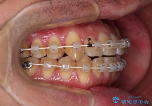 八重歯とクロスバイト 目立たないワイヤー装置で矯正治療の治療中