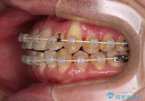 八重歯とクロスバイト 目立たないワイヤー装置で矯正治療の治療中