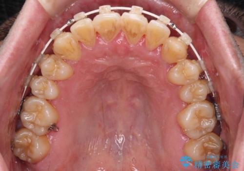 八重歯とクロスバイト　目立たないワイヤー装置で矯正治療の治療中