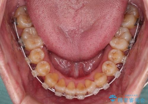 八重歯とクロスバイト 目立たないワイヤー装置で矯正治療の治療中