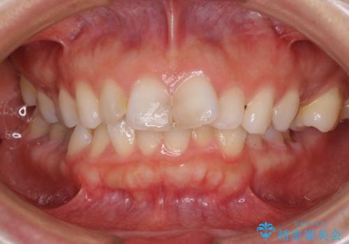 出っ歯と咬み合わせを改善　ワイヤー装置の抜歯矯正の治療前