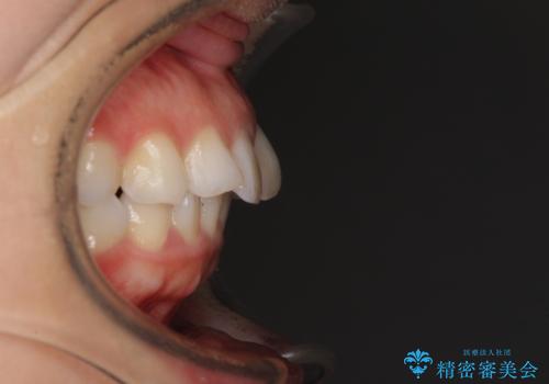 出っ歯と咬み合わせを改善　ワイヤー装置の抜歯矯正の治療前