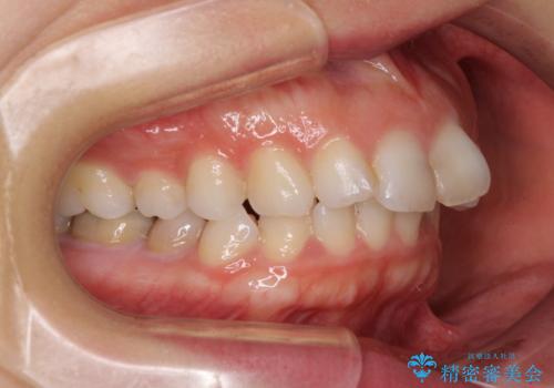 出っ歯と咬み合わせを改善 ワイヤー装置の抜歯矯正の治療前