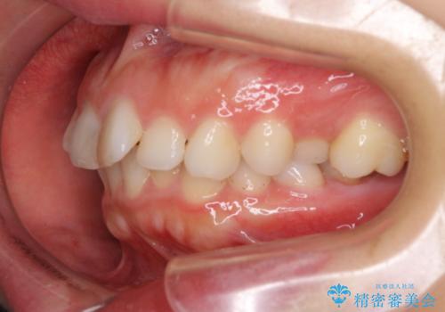 出っ歯と咬み合わせを改善 ワイヤー装置の抜歯矯正の治療前