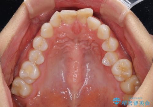 出っ歯と咬み合わせを改善 ワイヤー装置の抜歯矯正の治療前