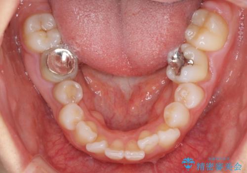 出っ歯と咬み合わせを改善 ワイヤー装置の抜歯矯正の治療前