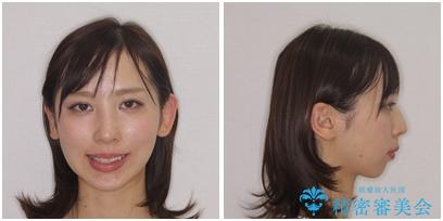 出っ歯と咬み合わせを改善 ワイヤー装置の抜歯矯正の治療前(顔貌)
