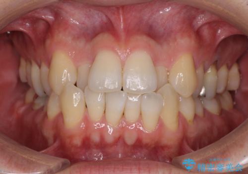 前歯のクロスバイト　目立たないワイヤー装置で矯正治療の症例 治療前