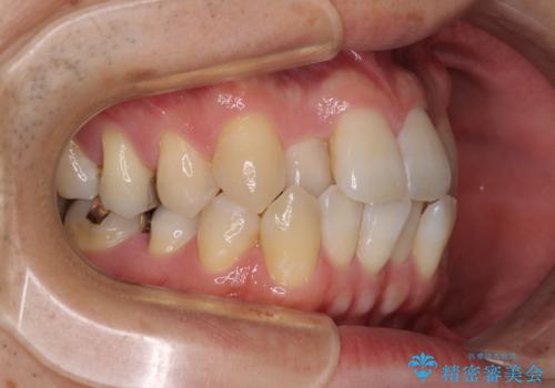 前歯のクロスバイト　目立たないワイヤー装置で矯正治療の治療前