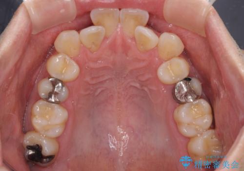 前歯のクロスバイト　目立たないワイヤー装置で矯正治療の治療前