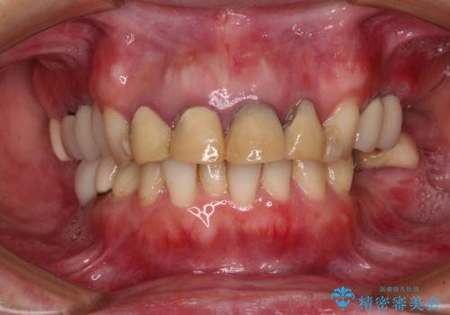 仮歯のまま放置した前歯 オールセラミッククラウンで自然な前歯にの治療前