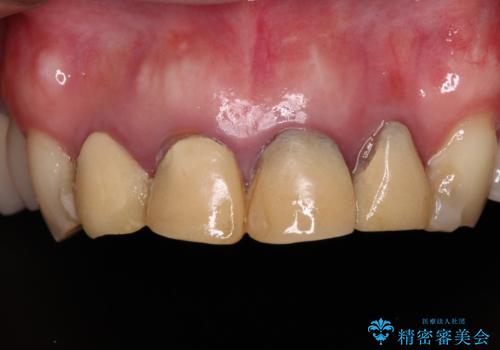仮歯のまま放置した前歯 オールセラミッククラウンで自然な前歯にの治療前