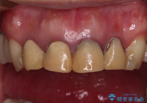 仮歯のまま放置した前歯　オールセラミッククラウンで自然な前歯にの治療前