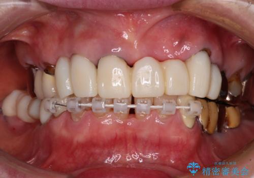 前歯をきれいにしたい　インプラントや部分矯正を用いた総合歯科治療の治療中