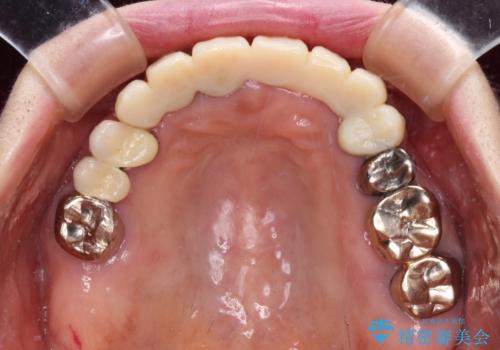 前歯をきれいにしたい インプラントや部分矯正を用いた総合歯科治療の治療中