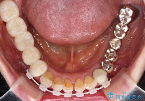 前歯をきれいにしたい インプラントや部分矯正を用いた総合歯科治療の治療中