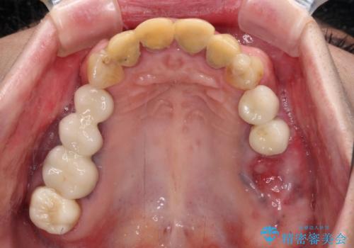 仮歯のまま放置した前歯 オールセラミッククラウンで自然な前歯にの治療前