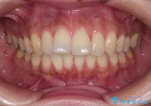 上顎前歯の突出を軽減　インビザラインによる抜歯矯正の症例 治療前