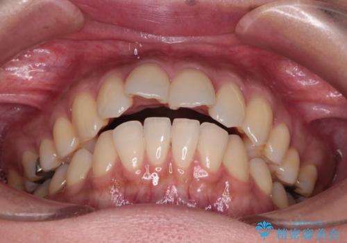 上顎前歯の突出を軽減　インビザラインによる抜歯矯正の治療前