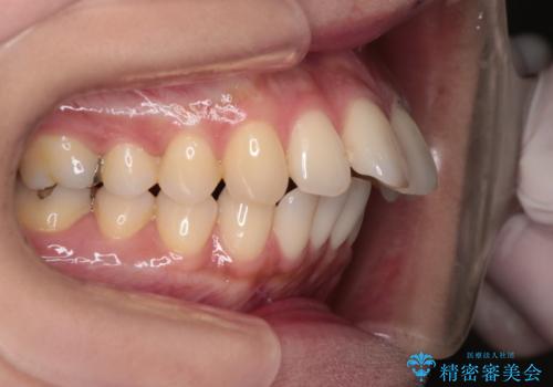 上顎前歯の突出を軽減 インビザラインによる抜歯矯正の治療前