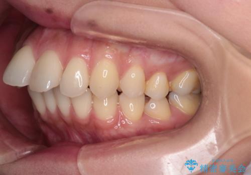 上顎前歯の突出を軽減 インビザラインによる抜歯矯正の治療前