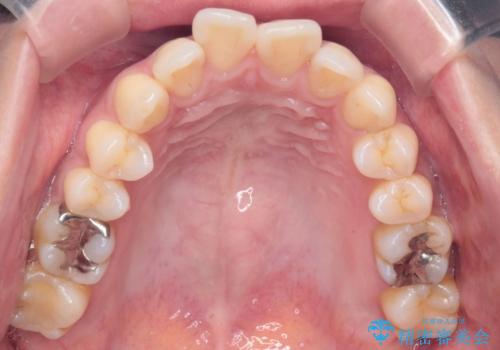 上顎前歯の突出を軽減 インビザラインによる抜歯矯正の治療前