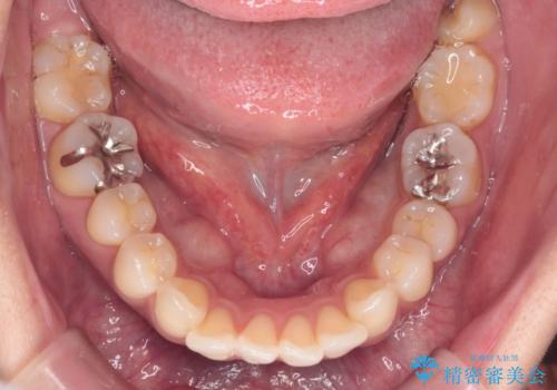 上顎前歯の突出を軽減 インビザラインによる抜歯矯正の治療前