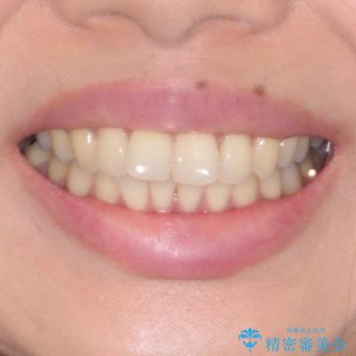 上顎前歯の突出を軽減　インビザラインによる抜歯矯正の治療前（顔貌）