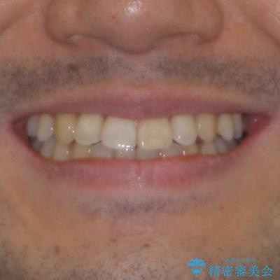 左右の八重歯が気になる ワイヤー装置での咬み合わせ改善の治療後(顔貌)