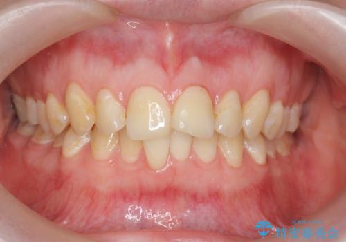 マウスピース矯正で行う出っ歯の治療の症例 治療前