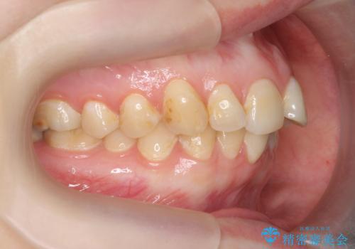 マウスピース矯正で行う出っ歯の治療の治療前