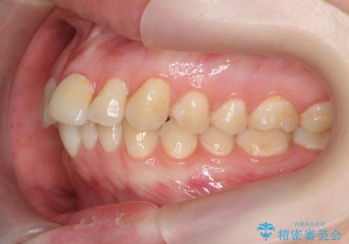 マウスピース矯正で行う出っ歯の治療の治療前