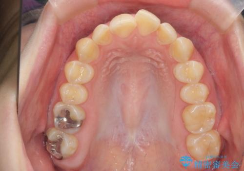 マウスピース矯正で行う出っ歯の治療の治療前