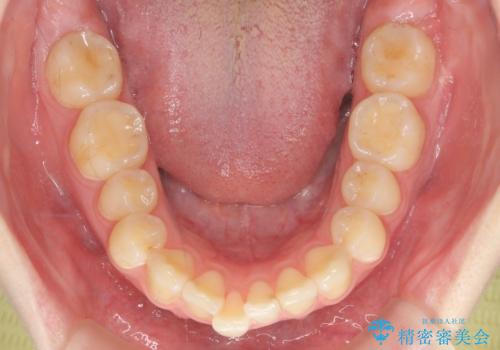 マウスピース矯正で行う出っ歯の治療の治療前