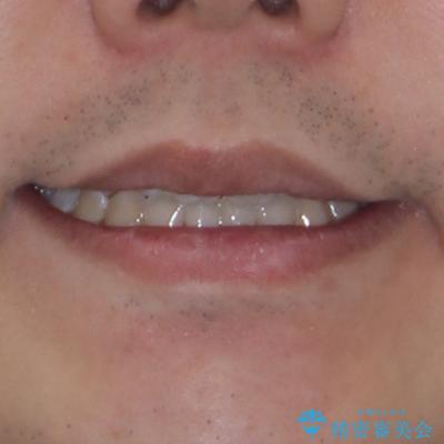 口元の突出感を改善　受け口傾向の咬み合わせの抜歯矯正の治療後（顔貌）