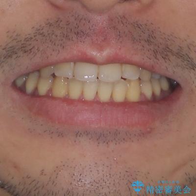 八重歯とクロスバイト　目立たないワイヤー装置で矯正治療の治療後（顔貌）