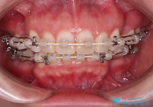 出っ歯と咬み合わせを改善 ワイヤー装置の抜歯矯正の治療中