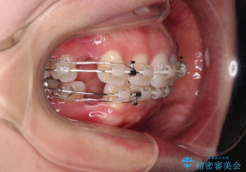 出っ歯と咬み合わせを改善 ワイヤー装置の抜歯矯正の治療中