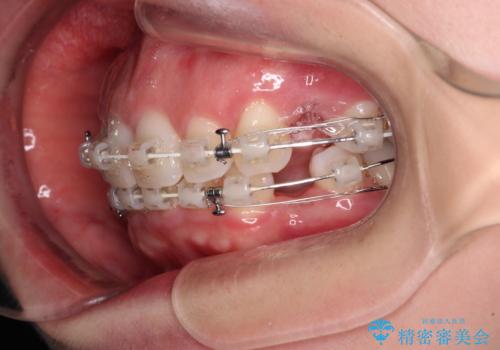出っ歯と咬み合わせを改善　ワイヤー装置の抜歯矯正の治療中