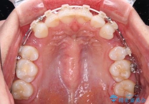 出っ歯と咬み合わせを改善 ワイヤー装置の抜歯矯正の治療中