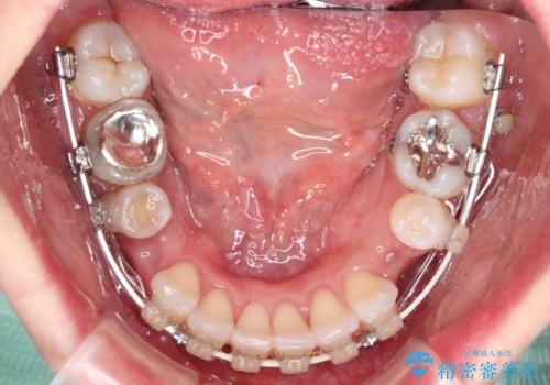 出っ歯と咬み合わせを改善 ワイヤー装置の抜歯矯正の治療中