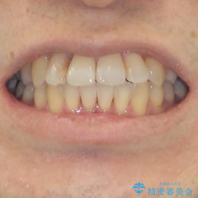 前歯のクロスバイト　目立たないワイヤー装置で矯正治療の治療後（顔貌）